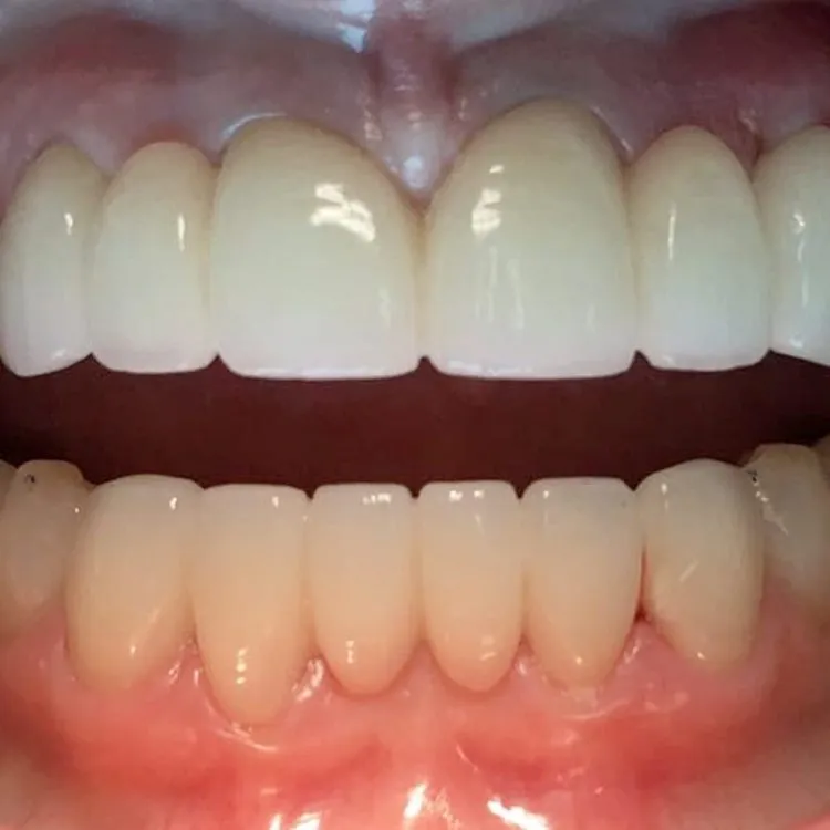 Dental Implants in Costa Rica