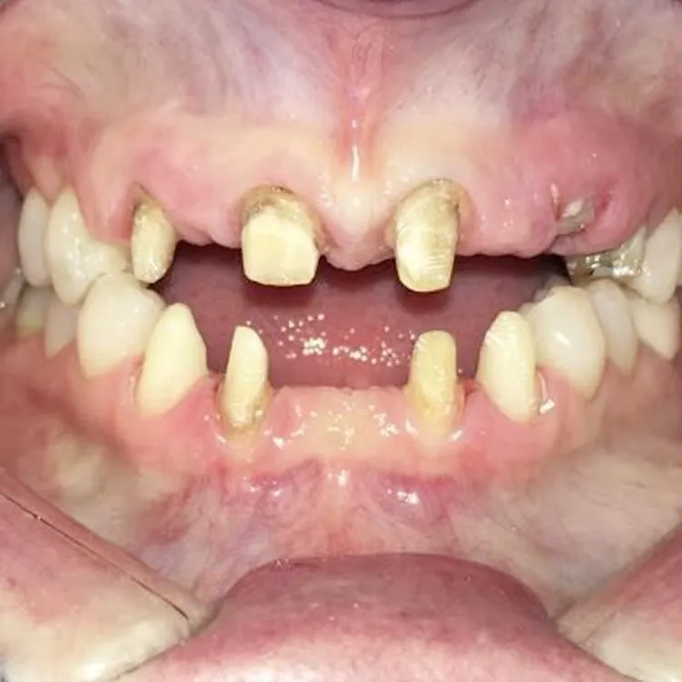 Dental Implants Costa Rica