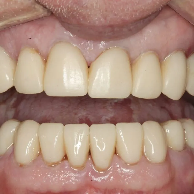 Full Mouth Reconstruction in  Costa Rica