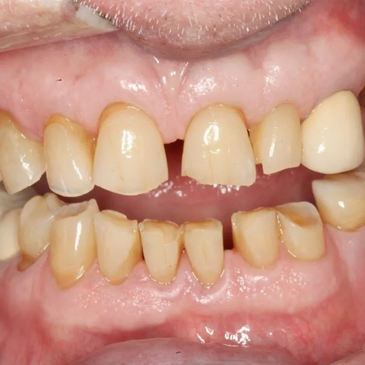 Full Mouth Reconstruction Costa Rica