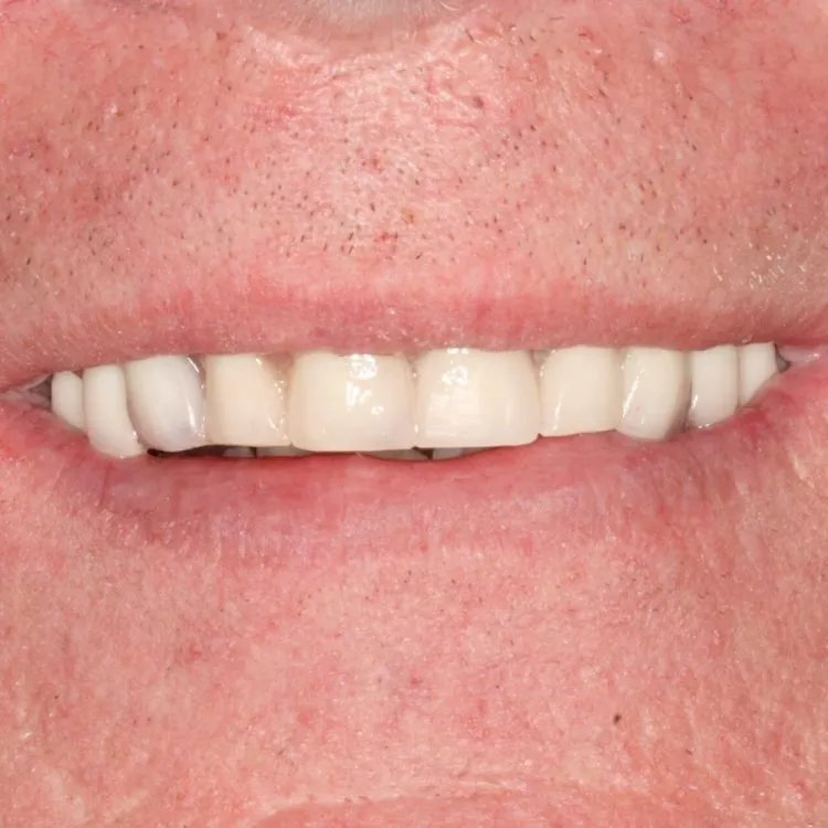 All on 5 implants Costa Rica