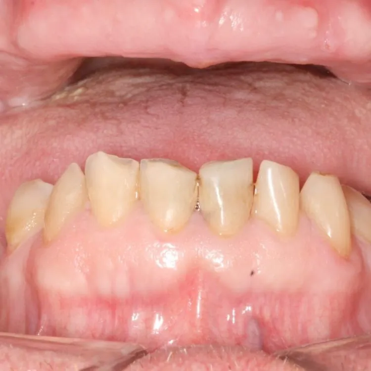 All on 5 Dental Implants Costa Rica