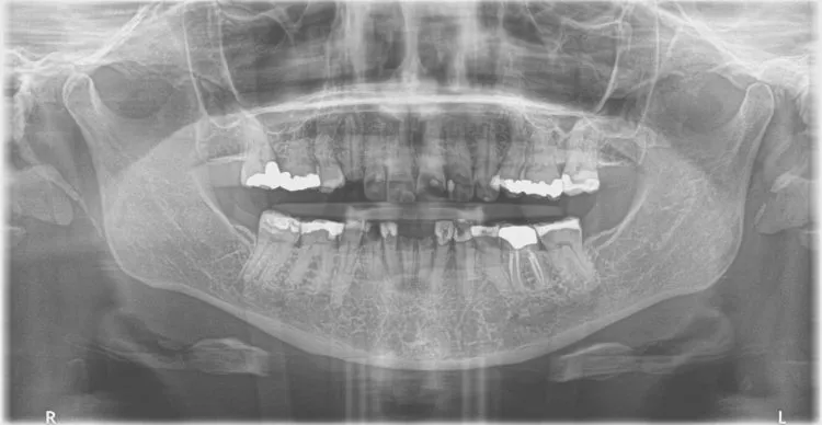 full mouth dental xray